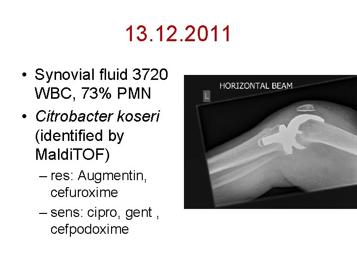 13. 12. 2011 • Synovial fluid 3720 WBC, 73% PMN • Citrobacter koseri (identified
