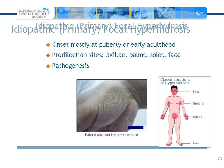 Idiopathic (Primary) Focal Hyperhidrosis 20 