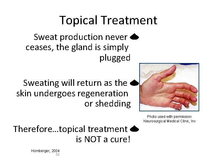 Topical Treatment Sweat production never ceases, the gland is simply plugged Sweating will return