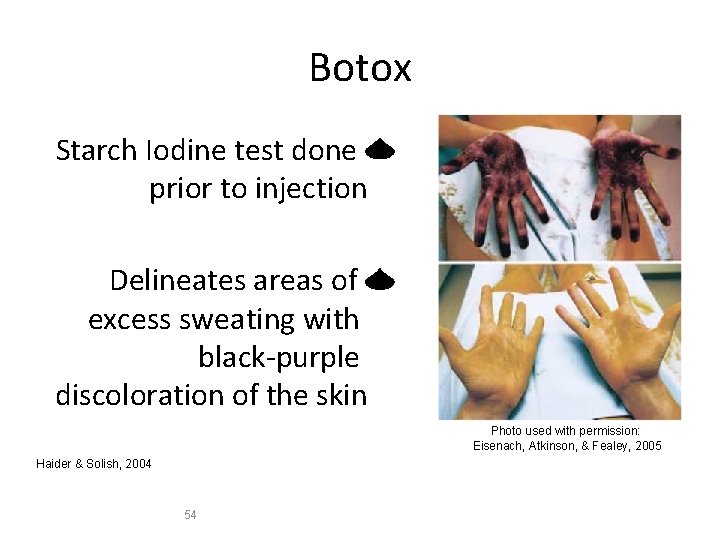 Botox Starch Iodine test done prior to injection Delineates areas of excess sweating with