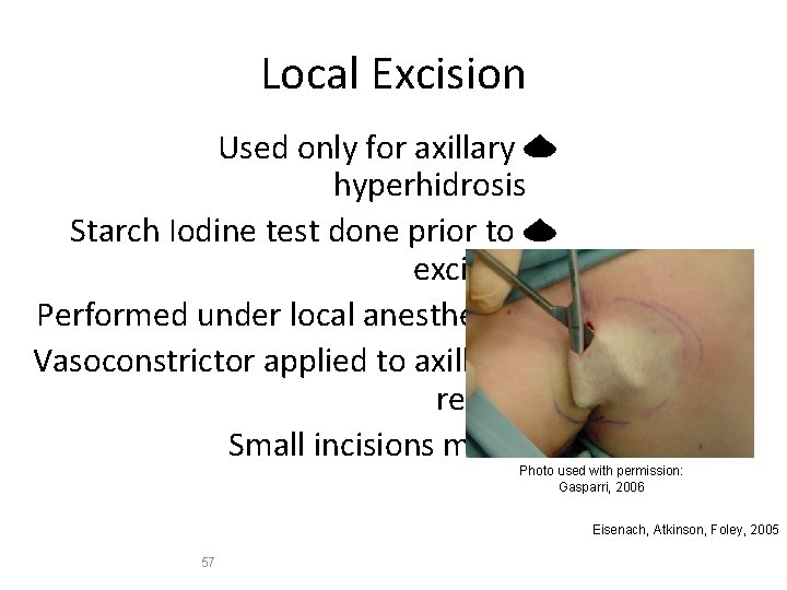 Local Excision Used only for axillary hyperhidrosis Starch Iodine test done prior to excision