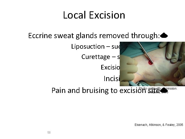 Local Excision Eccrine sweat glands removed through: Liposuction – suctioned out Curettage – scraped