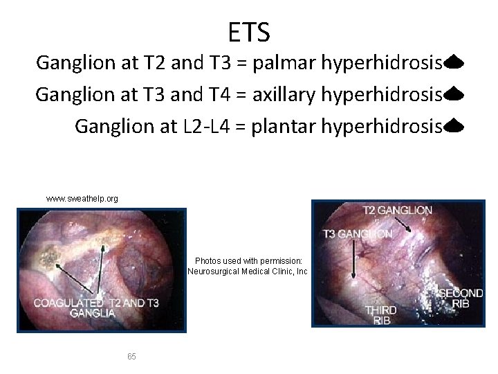 ETS Ganglion at T 2 and T 3 = palmar hyperhidrosis Ganglion at T