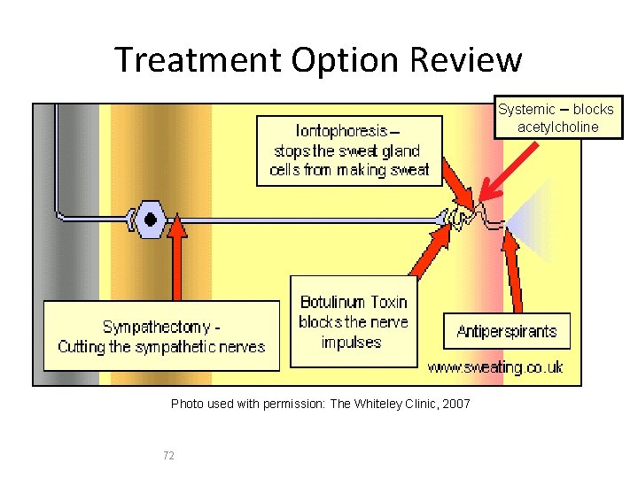 Treatment Option Review Systemic – blocks acetylcholine Photo used with permission: The Whiteley Clinic,