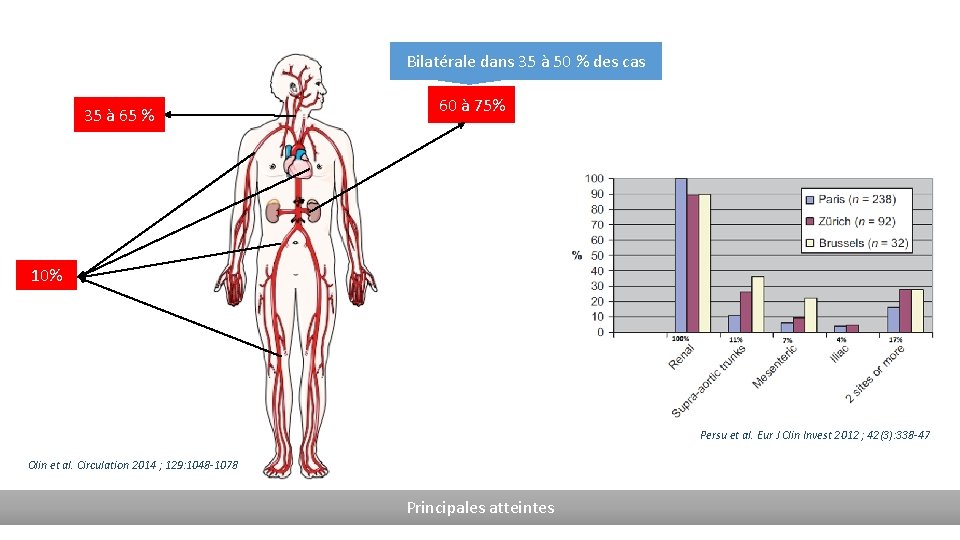 Bilatérale dans 35 à 50 % des cas 35 à 65 % 60 à