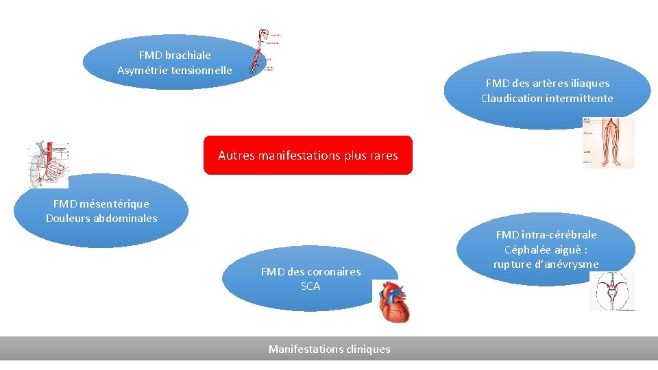 FMD brachiale Asymétrie tensionnelle FMD des artères iliaques Claudication intermittente Autres manifestations plus rares