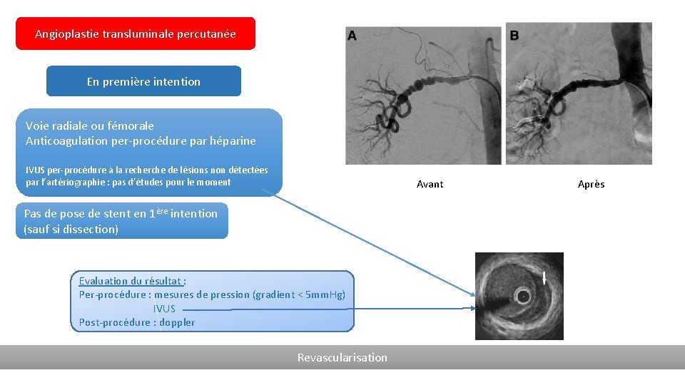 Angioplastie transluminale percutanée En première intention Voie radiale ou fémorale Anticoagulation per-procédure par héparine