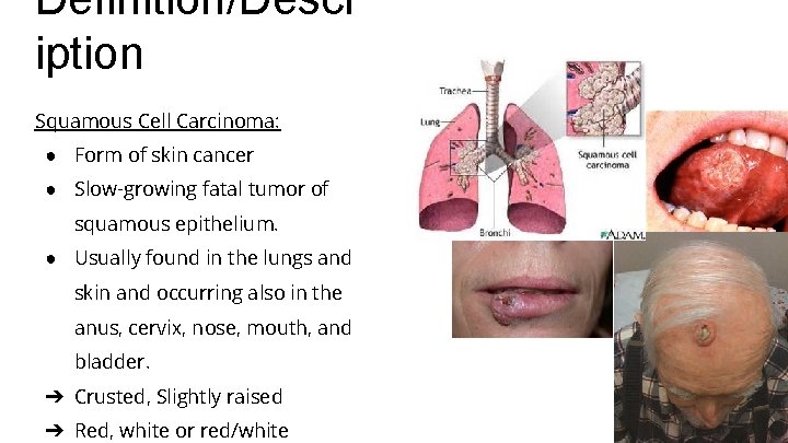 Definition/Descr iption Squamous Cell Carcinoma: ● Form of skin cancer ● Slow-growing fatal tumor