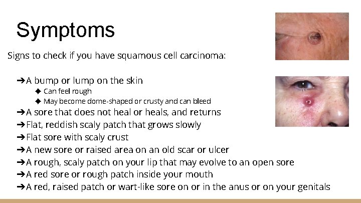 Symptoms Signs to check if you have squamous cell carcinoma: ➔A bump or lump