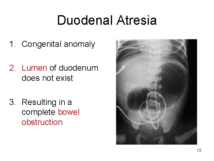 Duodenal Atresia 1. Congenital anomaly 2. Lumen of duodenum does not exist 3. Resulting