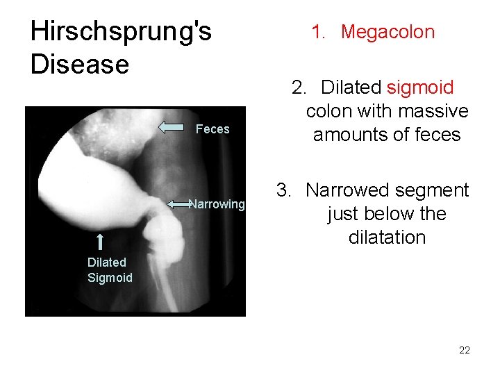 Hirschsprung's Disease Feces Narrowing 1. Megacolon 2. Dilated sigmoid colon with massive amounts of