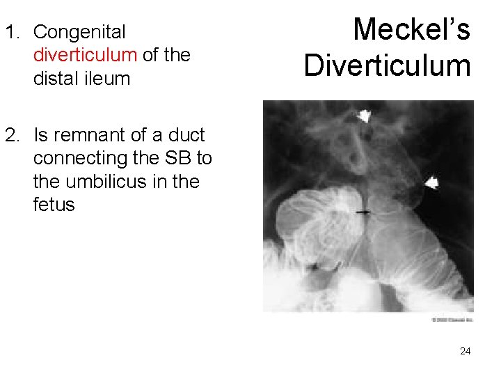 1. Congenital diverticulum of the distal ileum Meckel’s Diverticulum 2. Is remnant of a