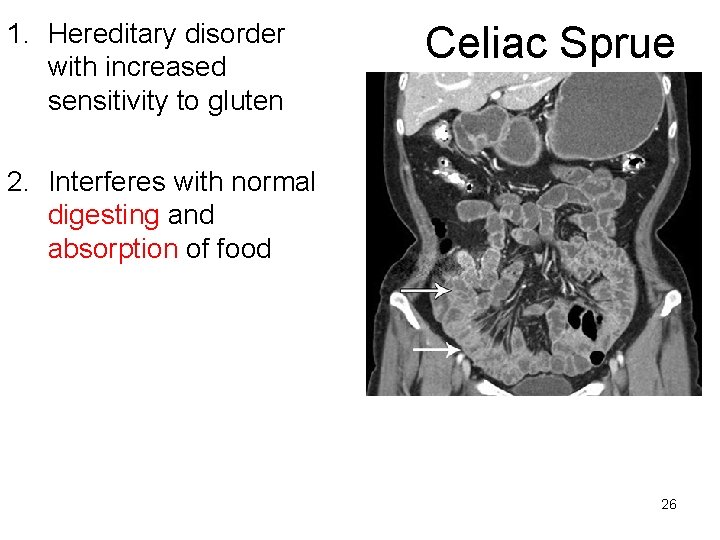 1. Hereditary disorder with increased sensitivity to gluten Celiac Sprue 2. Interferes with normal