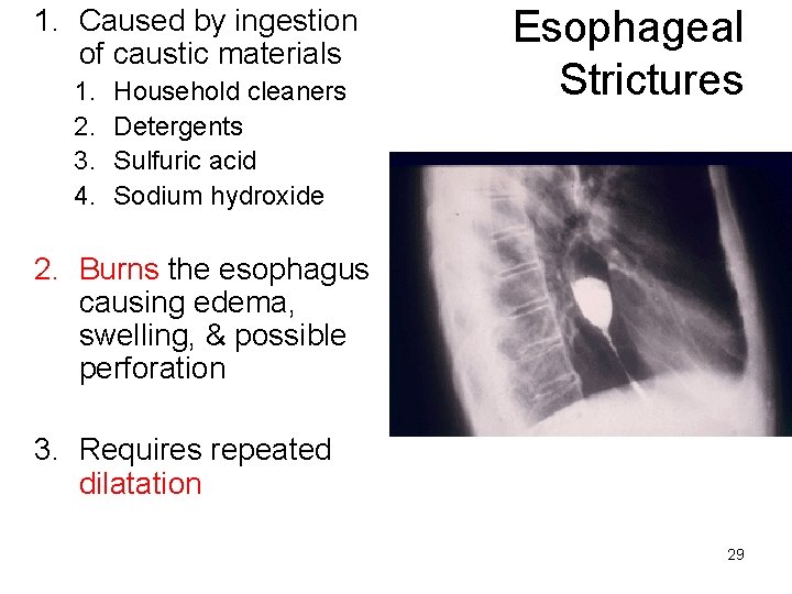 1. Caused by ingestion of caustic materials 1. 2. 3. 4. Household cleaners Detergents