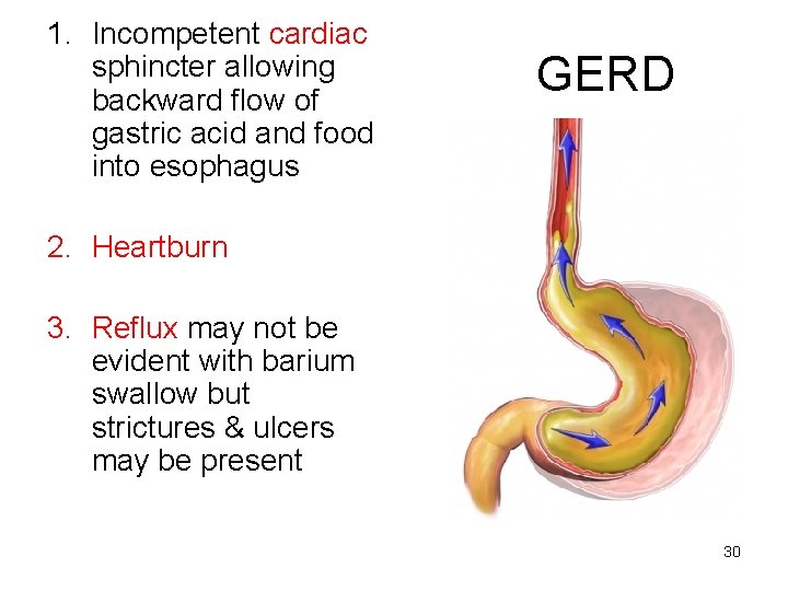 1. Incompetent cardiac sphincter allowing backward flow of gastric acid and food into esophagus