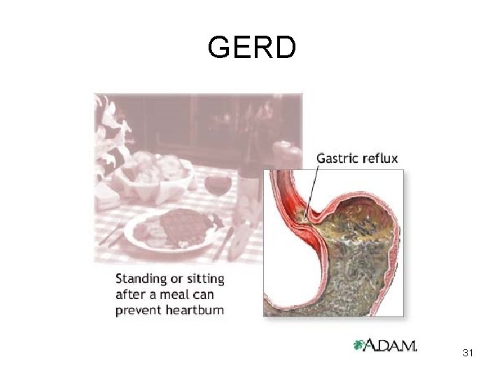 GERD 31 