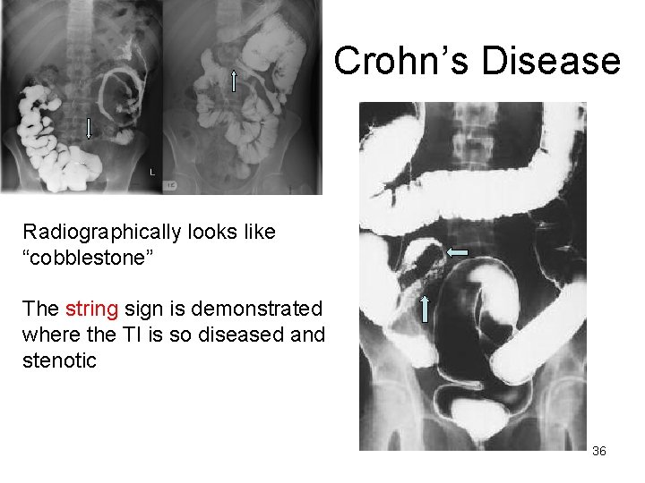 Crohn’s Disease Radiographically looks like “cobblestone” The string sign is demonstrated where the TI