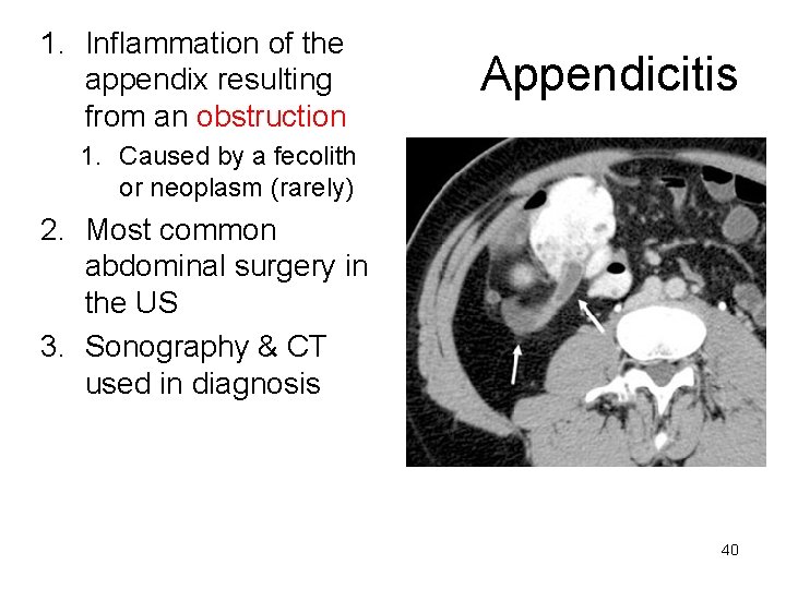 1. Inflammation of the appendix resulting from an obstruction Appendicitis 1. Caused by a