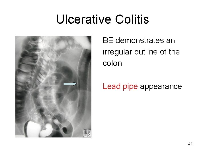 Ulcerative Colitis BE demonstrates an irregular outline of the colon Lead pipe appearance 41