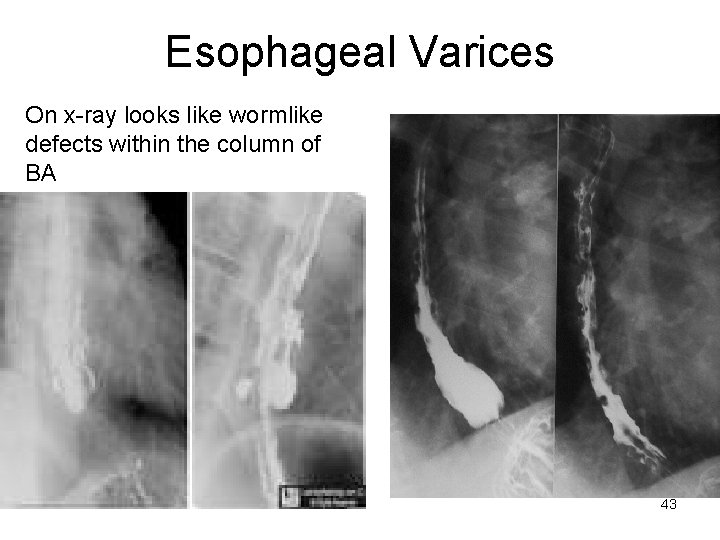 Esophageal Varices On x-ray looks like wormlike defects within the column of BA 43