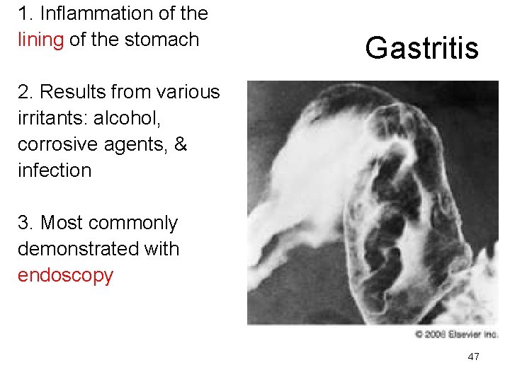 1. Inflammation of the lining of the stomach Gastritis 2. Results from various irritants: