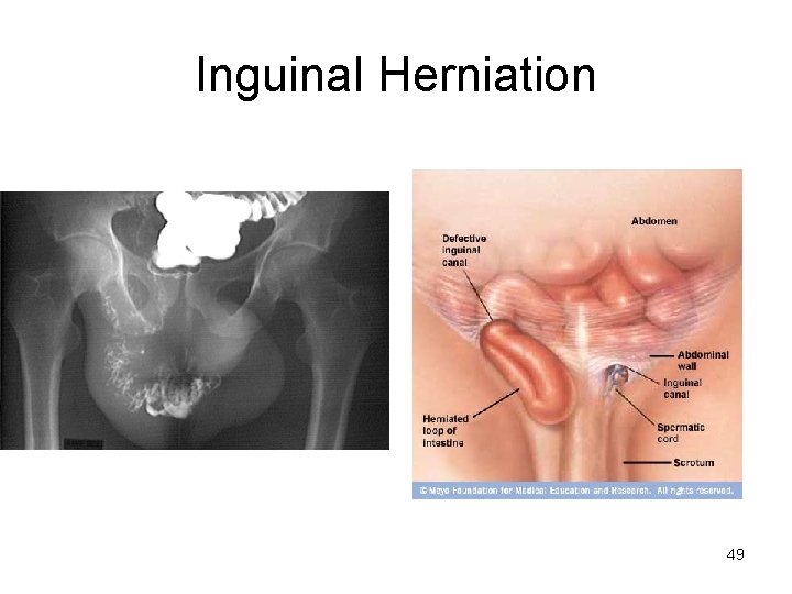 Inguinal Herniation 49 