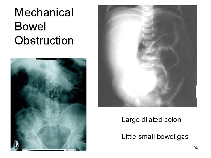 Mechanical Bowel Obstruction Large dilated colon Little small bowel gas 55 