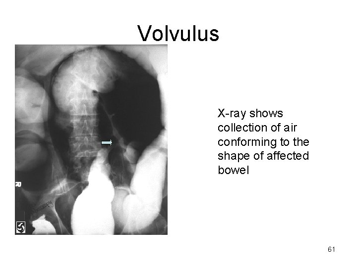 Volvulus X-ray shows collection of air conforming to the shape of affected bowel 61