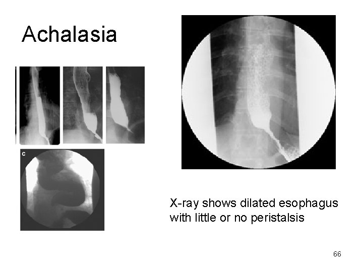 Achalasia X-ray shows dilated esophagus with little or no peristalsis 66 