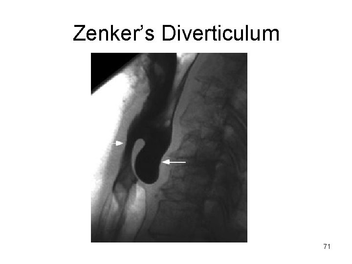 Zenker’s Diverticulum 71 