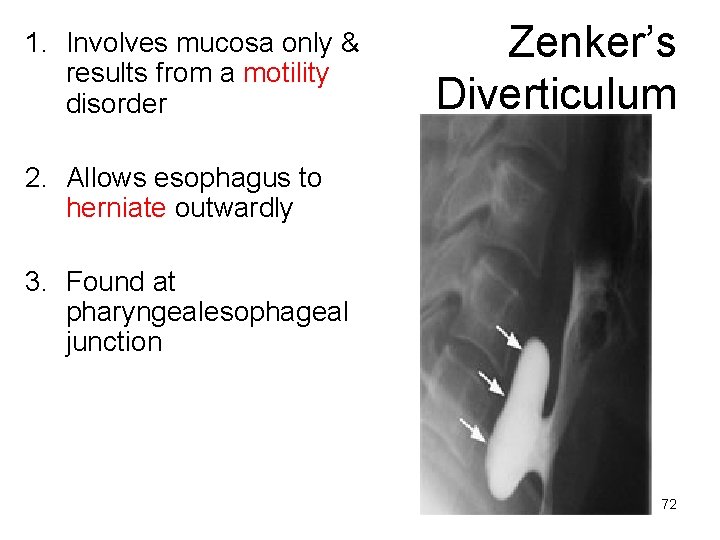1. Involves mucosa only & results from a motility disorder Zenker’s Diverticulum 2. Allows