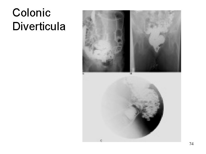 Colonic Diverticula 74 