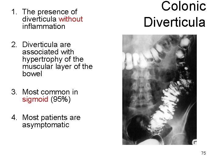 1. The presence of diverticula without inflammation Colonic Diverticula 2. Diverticula are associated with