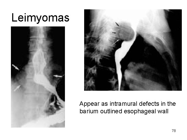 Leimyomas Appear as intramural defects in the barium outlined esophageal wall 78 