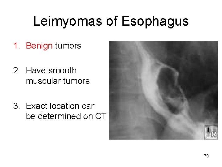 Leimyomas of Esophagus 1. Benign tumors 2. Have smooth muscular tumors 3. Exact location