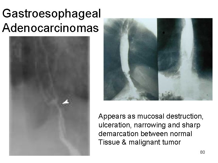 Gastroesophageal Adenocarcinomas Appears as mucosal destruction, ulceration, narrowing and sharp demarcation between normal Tissue