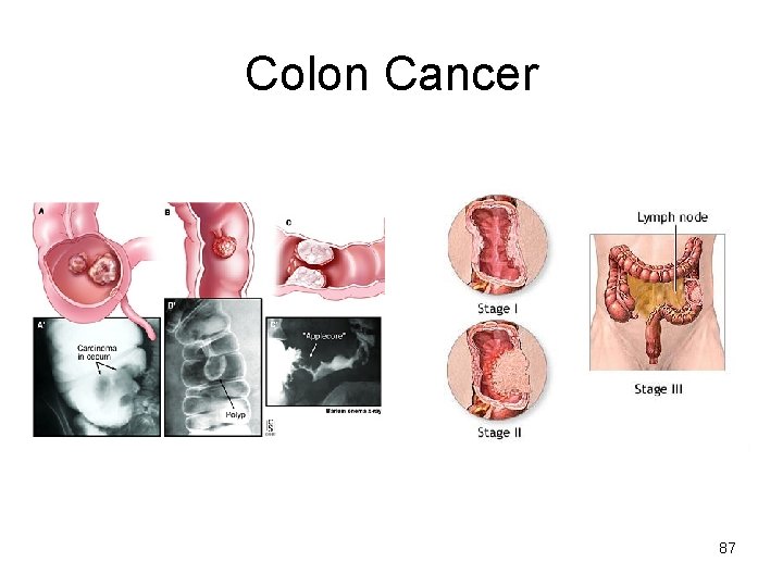 Colon Cancer 87 