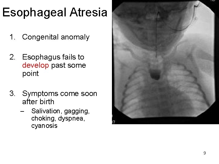 Esophageal Atresia 1. Congenital anomaly 2. Esophagus fails to develop past some point 3.