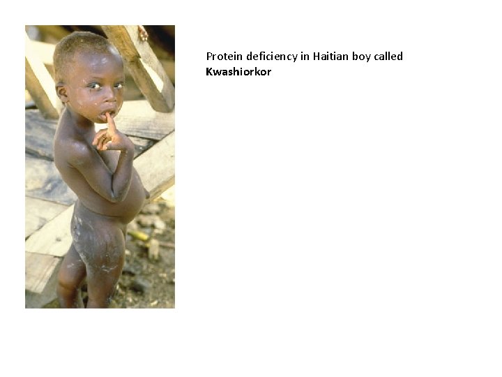 Protein deficiency in Haitian boy called Kwashiorkor 