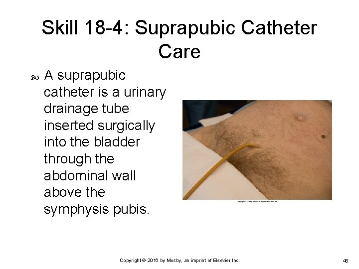 Skill 18 -4: Suprapubic Catheter Care A suprapubic catheter is a urinary drainage tube