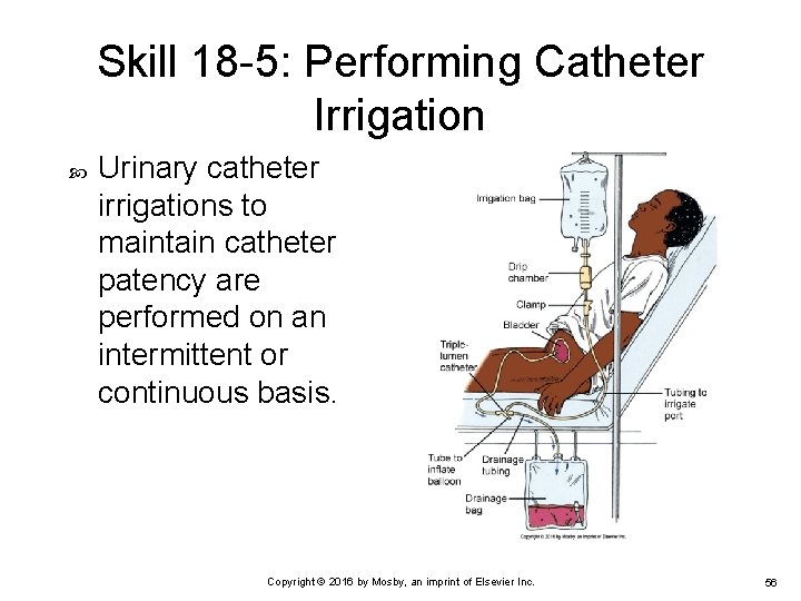 Skill 18 -5: Performing Catheter Irrigation Urinary catheter irrigations to maintain catheter patency are