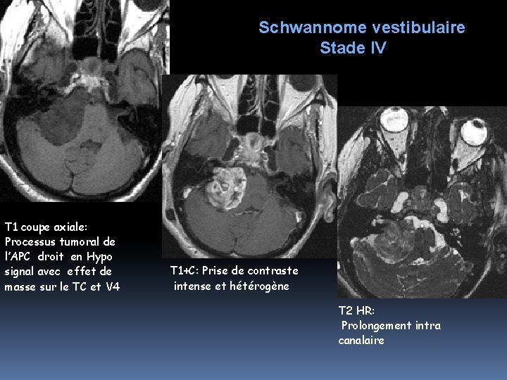 Schwannome vestibulaire Stade IV T 1 coupe axiale: Processus tumoral de l’APC droit en