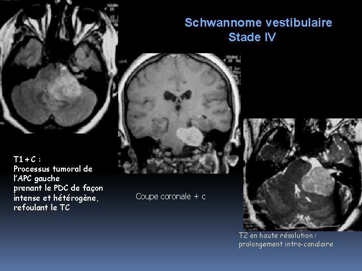 Schwannome vestibulaire Stade IV T 1 + C : Processus tumoral de l’APC gauche