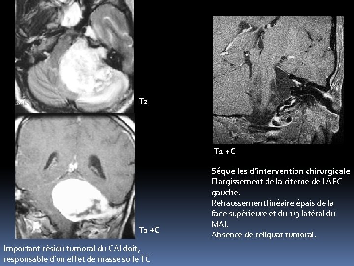 T 2 T 1 +C Important résidu tumoral du CAI doit, responsable d’un effet