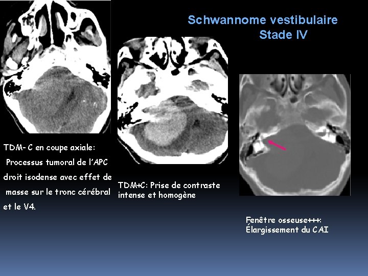 Schwannome vestibulaire Stade IV TDM- C en coupe axiale: Processus tumoral de l’APC droit