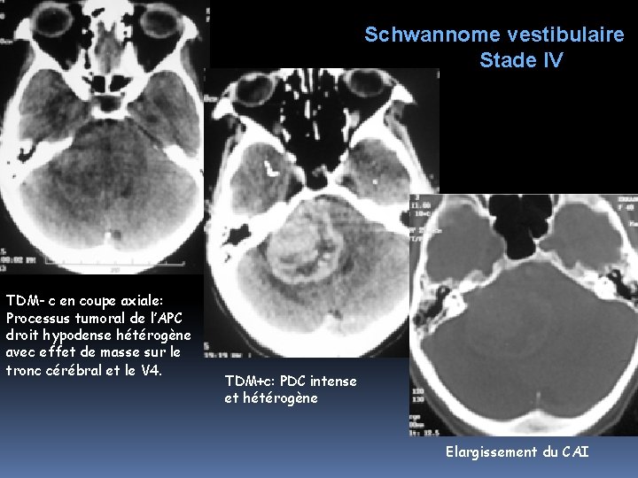 Schwannome vestibulaire Stade IV TDM- c en coupe axiale: Processus tumoral de l’APC droit