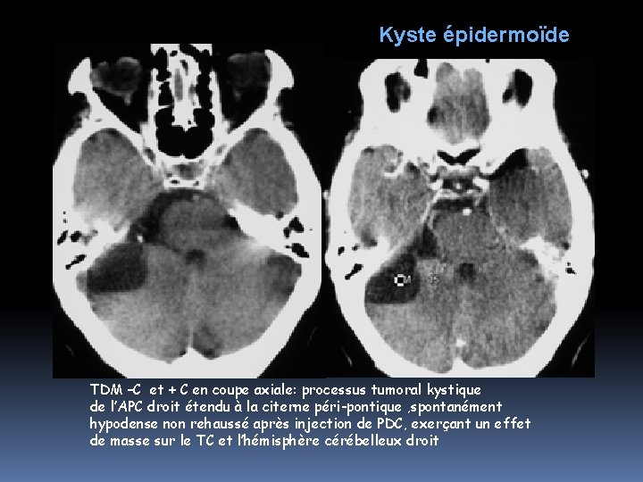 Kyste épidermoïde TDM –C et + C en coupe axiale: processus tumoral kystique de