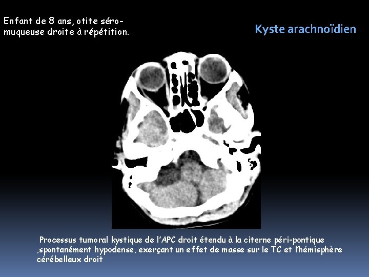 Enfant de 8 ans, otite séromuqueuse droite à répétition. Kyste arachnoïdien Processus tumoral kystique