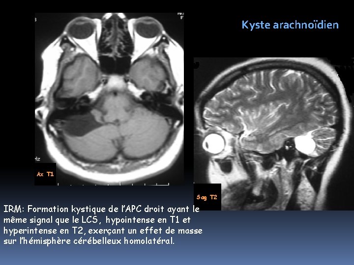 Kyste arachnoïdien Ax T 1 Sag T 2 IRM: Formation kystique de l’APC droit