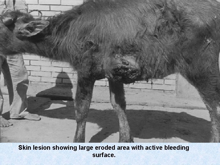 Skin lesion showing large eroded area with active bleeding surface. 